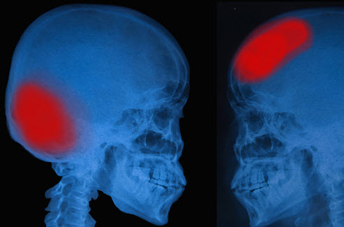 Head Injury