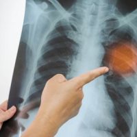 BrokenRib[1]